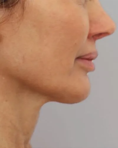 Profound RF skin tightening Dublin - after photo of the jawline and neck in profile Jawline and neck in profile after Profound RF skin tightening at our Dublin clinic