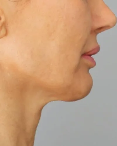 Profound RF skin tightening Dublin - before photo of the jawline and neck in profile Jawline and neck in profile before Profound RF skin tightening at our Dublin clinic